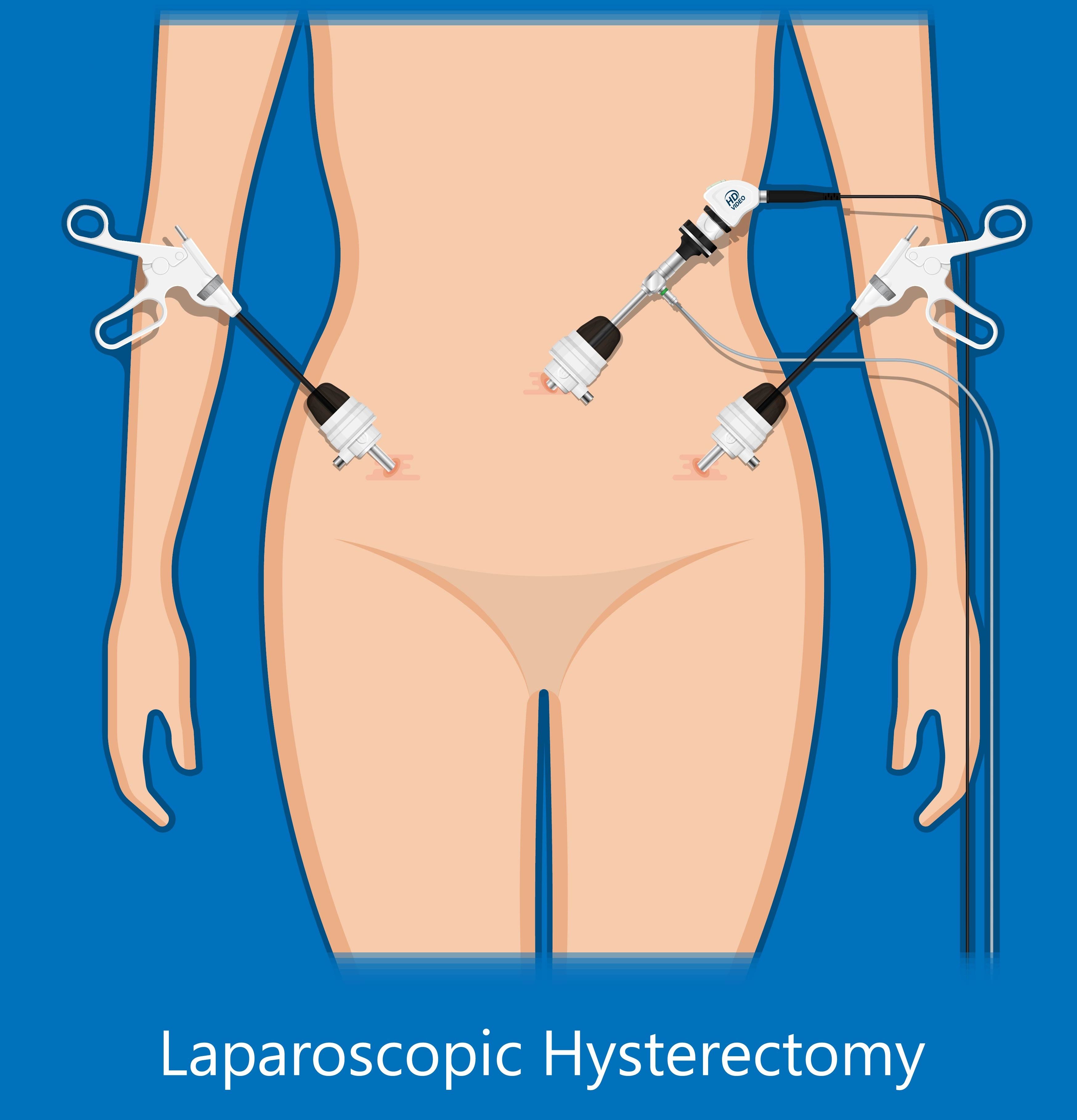 Graphic showing laparoscopic hysterectomy
